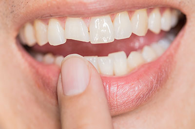 A close-up of a person's smiling mouth with crooked teeth, holding their finger in front of the teeth.